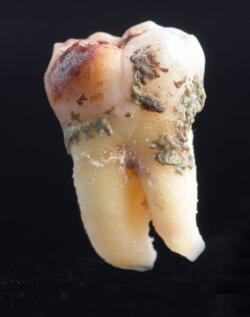 曾经有一位牙医把自然脱落的牙齿拍成微距照片发到微信上,引起了很多