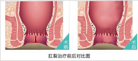 肛裂可以形成哪些危害?