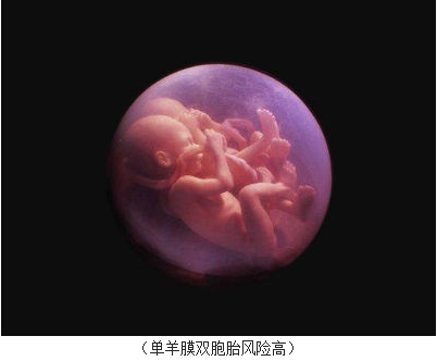 生命奇迹 美罕见单羊膜双胞胎女婴牵手出生