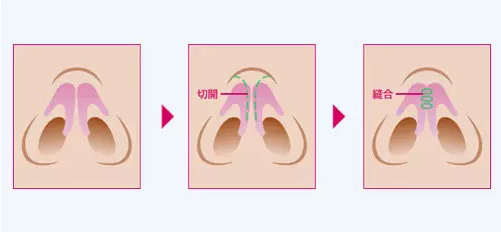 鼻翼缩小术-大多数的亚洲人都有必要做