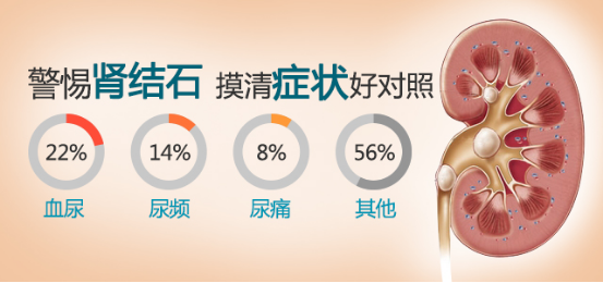 右肾2980颗结石