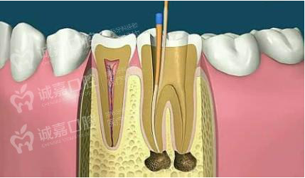 重庆做根管治疗多少钱