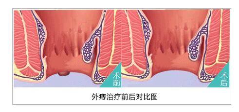 痔疮的危害有哪些呢?重庆医博小贴士