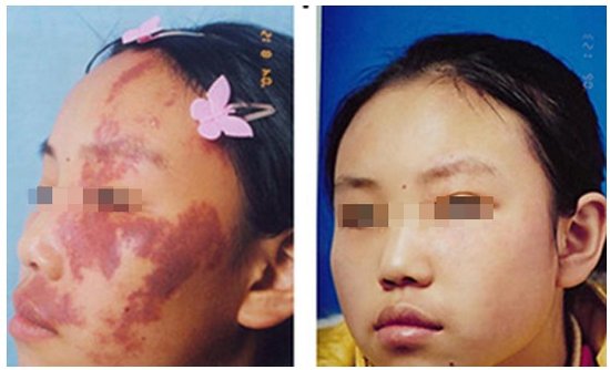 什么年龄治疗胎记最好?