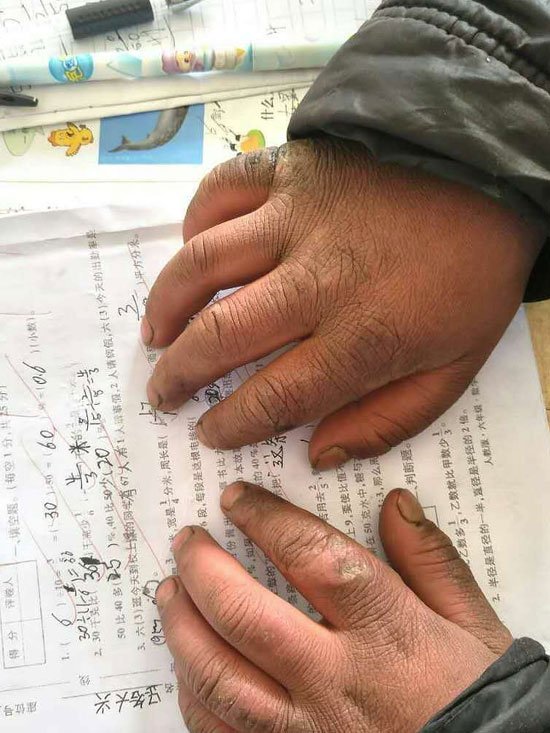 小孩凍紅的雙手,轉山包小學校長付恆供圖 我也做過「冰花男孩」,我知道讚美苦難有多殘忍