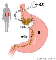 英国人用胃<em>结扎</em>和催眠术减肥_出国新闻大