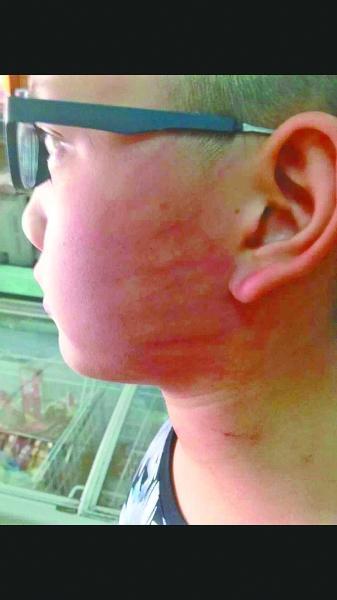 图为被打的王同学脸上伤痕明显(挨打当天拍摄)