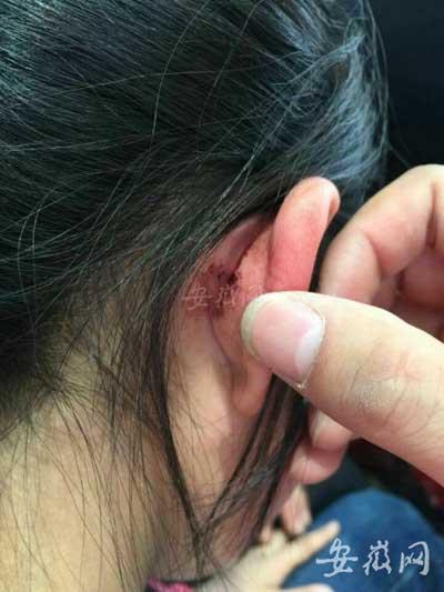 安徽小学生因做错题被老师体罚 双耳根被撕裂