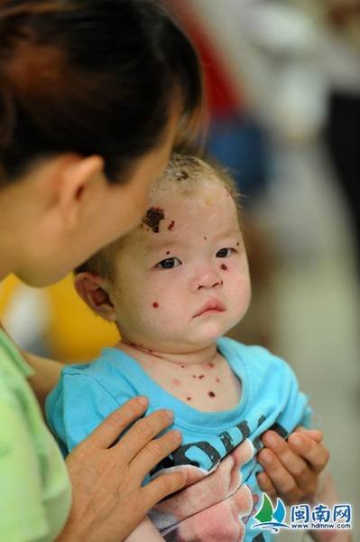 南安女婴浑身疱疹被弃医院 网友呼吁其父母现