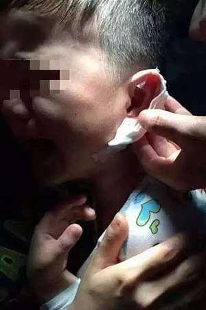 4岁男童左耳被幼儿园老师用订书机钉穿(图)