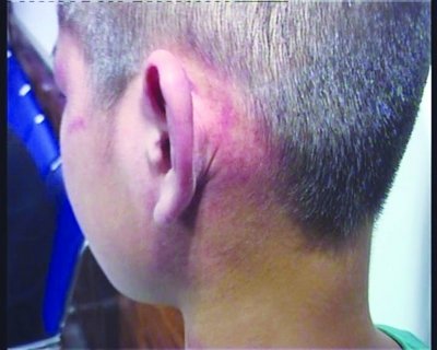 男孩遭补习班“老师”掌掴 脸上耳后多处青紫