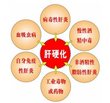 内科主治医师肝硬化核心知识点总结