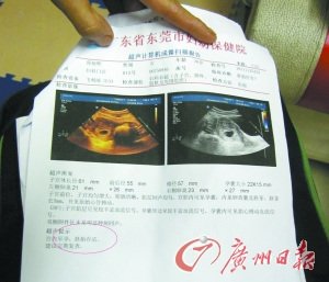 胎儿初检为死胎被建议流产 换医院检查证实存