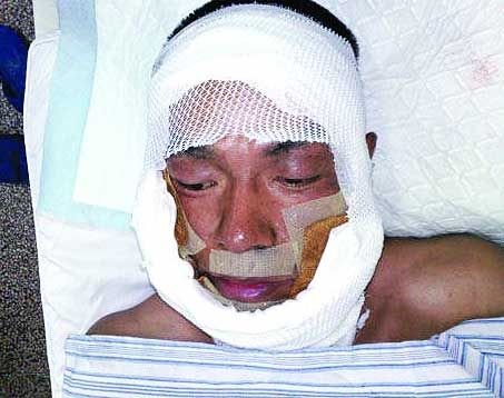 拍戏遭遇意外爆炸被烧伤 演员王挺获赔70万(图