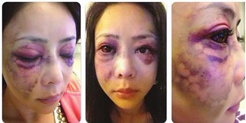 女星遭富豪男友虐打 眼球脸部严重淤血法庭上