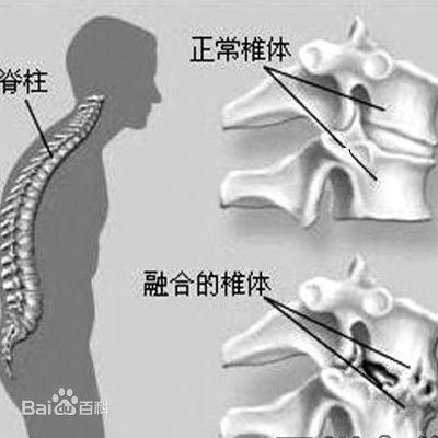 周杰伦脊柱炎严重：“治不好，唉，老人家了”