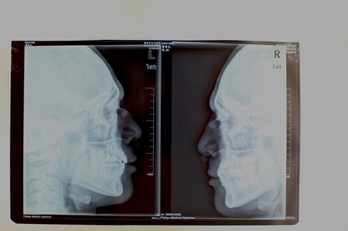 挥拳打歪鼻梁骨