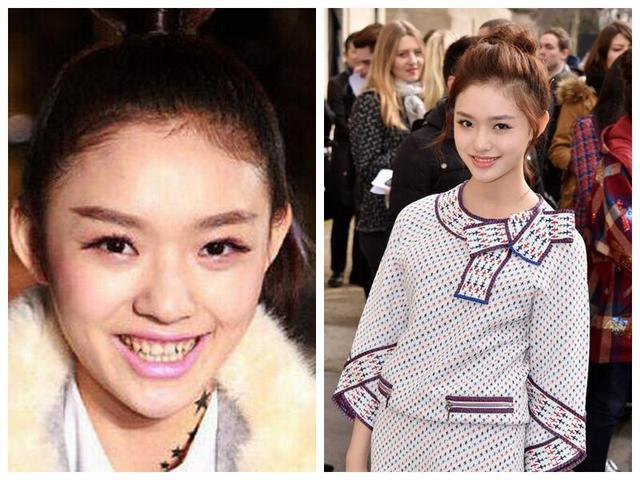 林允整牙就换脸?这可真不是帮女明星洗白