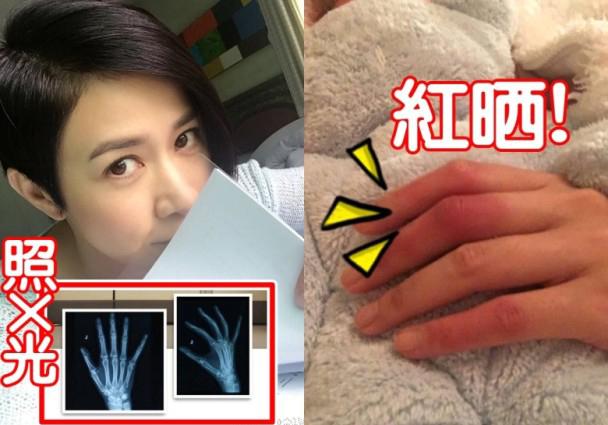 容易受伤的女人!佘诗曼拍打戏变红烧猪手