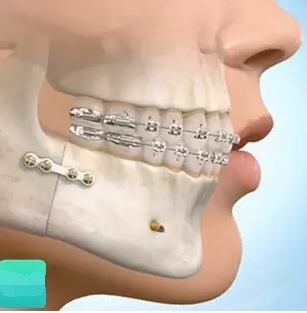 所以,拔个牙就能变成法律认证纯天然的美少女,这种事情想想就好啦,可