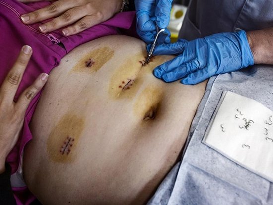 镜头记录西班牙女子胃旁路手术减肥历程