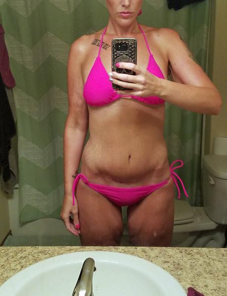 美国女子2年减肥153斤 导致皮肤松弛胸部下垂