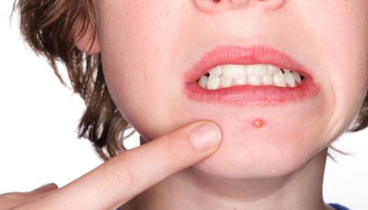 挤痘严重可致命!这些祛痘地雷千万别踩