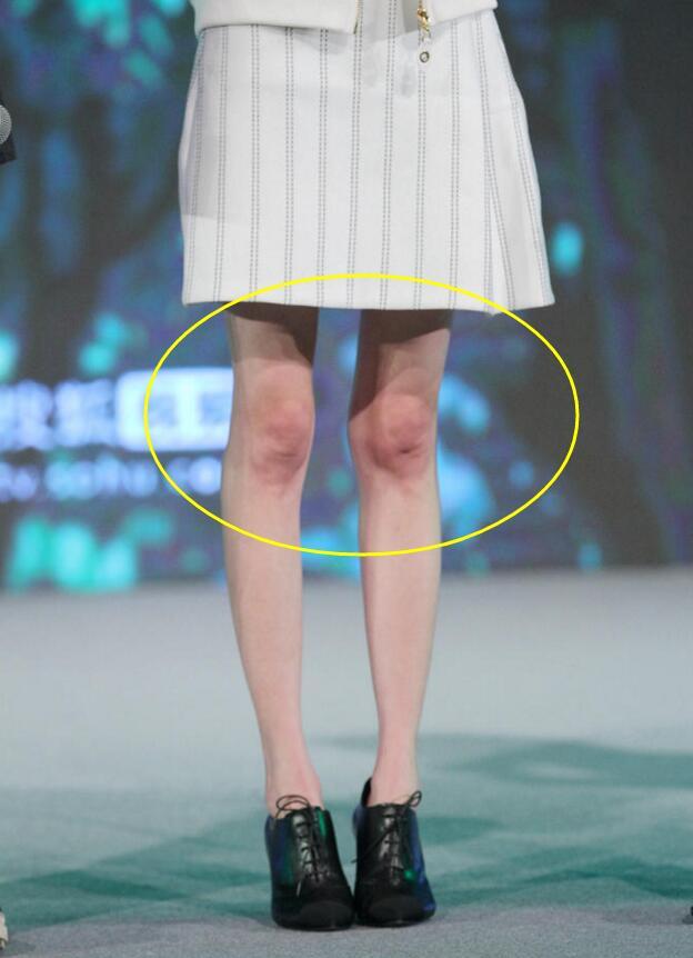 八公举:郑爽宋慧乔都有15岁的脸50岁的“丑膝盖”