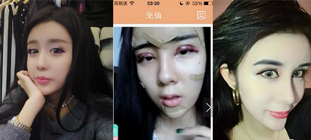 网上这组被大家吐槽的蛇精女照片应该是脂肪填充完的恢复期加上ps过度