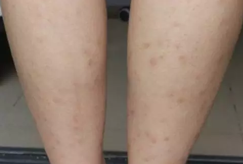张碧晨敢和奚梦瑶比腿,佩服!但她腿上这些疤是什么鬼…