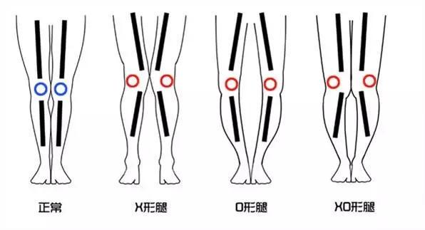 八公举：小腿外翻的原因不是骨头，拯救“剪刀腿”姿势.gif，变成长直美腿再来谢我