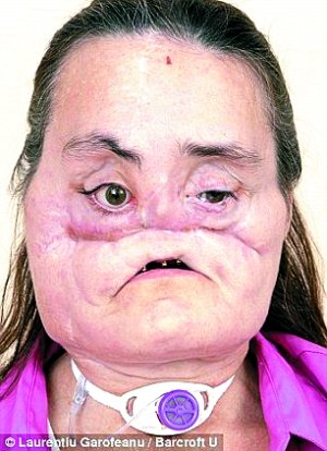 美国换脸女讲述重生生活:有脸真好(组图)