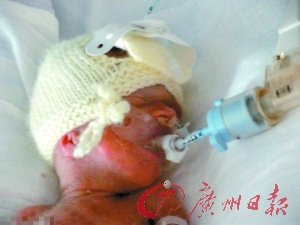 英最小双胞胎出生时仅23周 大小如成人手掌