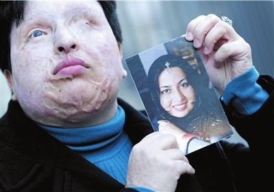 伊朗男子泼硫酸被判毁双眼 临刑前获受害人宽恕