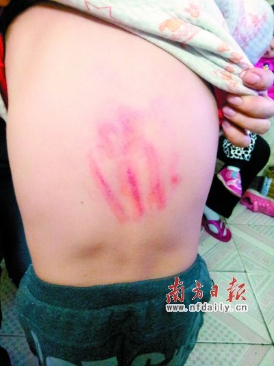 小学生遭老师体罚 后背留下血红掌印