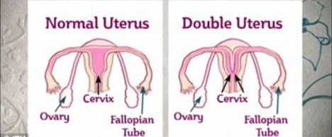 英女子长双子宫双阴道 几率仅百万分之一(<em>图</em>)_