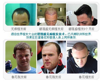 鲁尼植发的背后解析 关于公开披露与技术的一