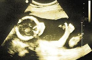 胎儿竖大拇指拍下b超写真