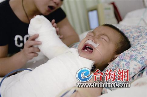 11个月女婴家中被开水烫伤 全身烫伤面积达40