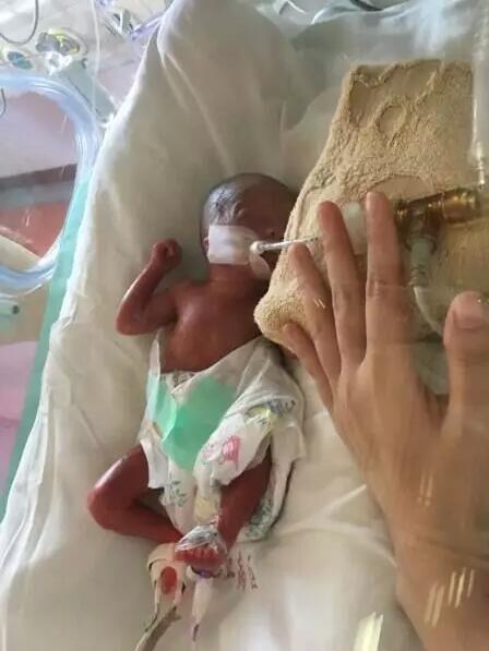 宁德早产女婴出生仅巴掌大 奇迹般活了下来