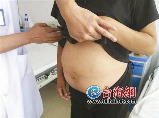 女子在腹内“养”巨型肿瘤7年 犹如大冬瓜
