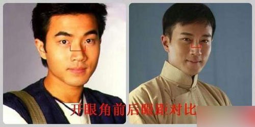 郑嘉颖林峰刘恺威 细数TVB被传整容的男明星