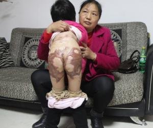 小钰晗屁股,双下肢大面积受伤