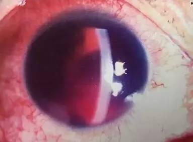 男子逛街时被鞭炮炸伤 眼睛出血成兔子眼