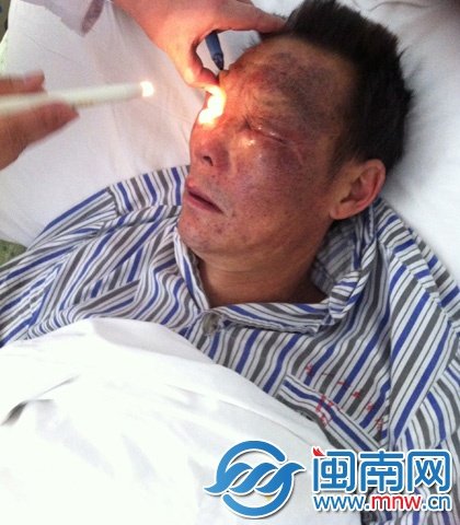 家具厂工人跌入硫酸池 眼角膜被灼伤(图)_大闽网_腾讯网