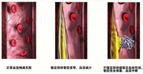 前者对心血管有保护作用,通常称之为"好胆固醇";后者一旦偏高,冠心病