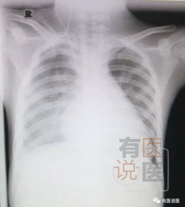 平潭男孩感冒三天突然病危 在医院抢救29天