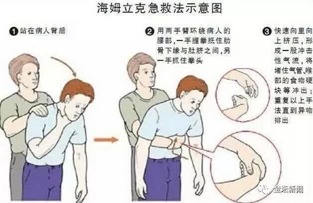 海姆立克急救法
