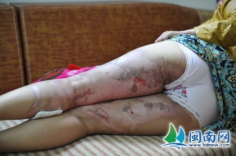 南安妙龄女为减肥拨火罐被烧伤 店家拒谈赔偿