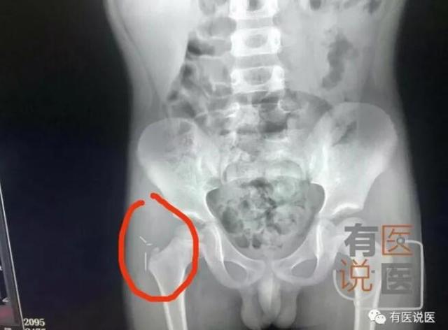 福州4岁男童被绣花针扎入臀部骨头 断成三截